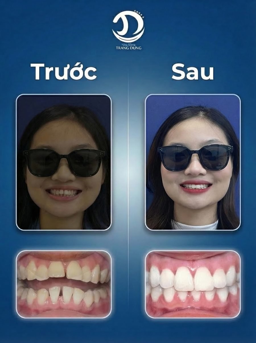 Trước và sau chỉnh nha