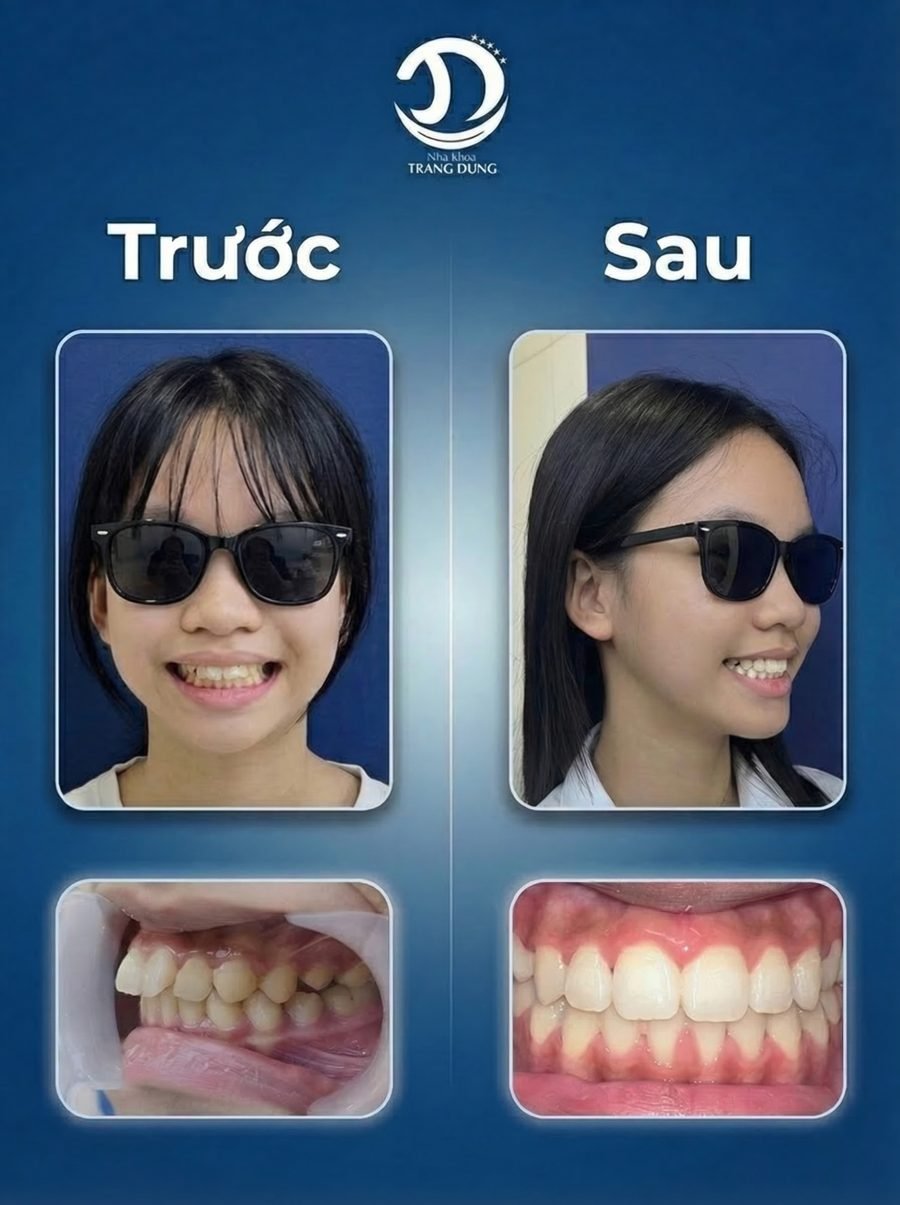 Trước và sau chỉnh nha