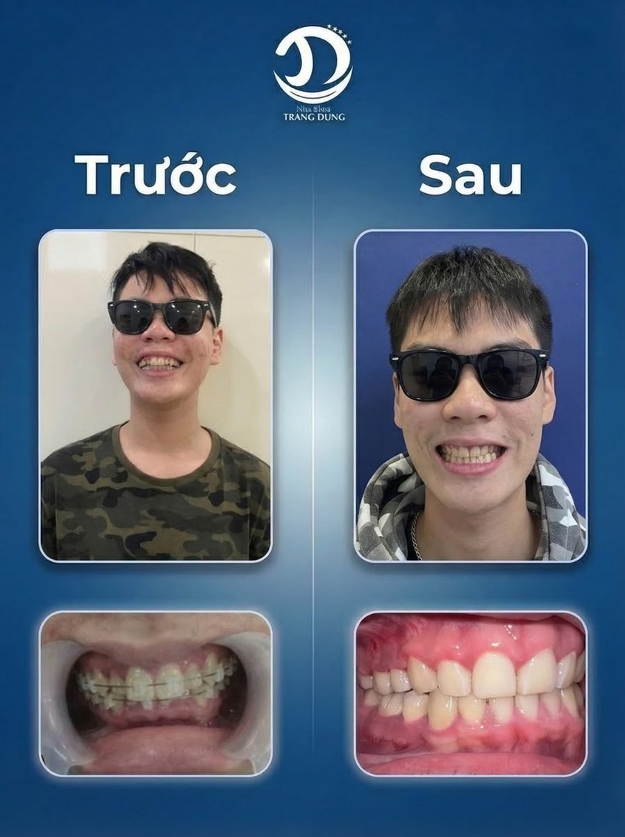 Trước và sau chỉnh nha