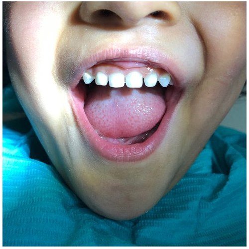 Răng sau khi hàn, đều và trắng