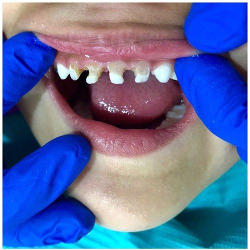Răng sún, sâu trước khi điều trị