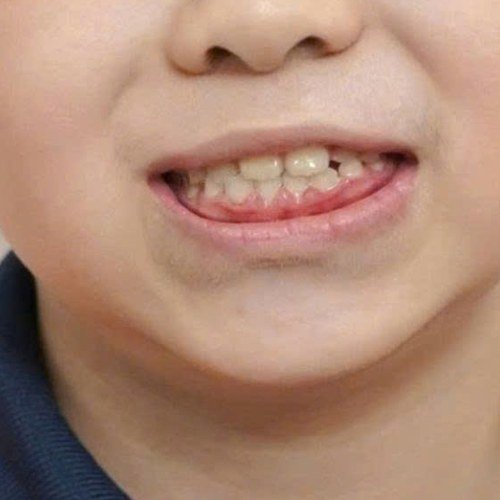 Răng đều hơn sau khi chỉnh