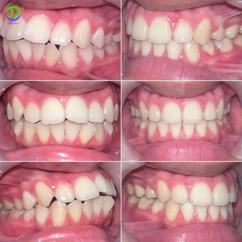 Trước và sau khi chỉnh nha của Quỳnh Hương